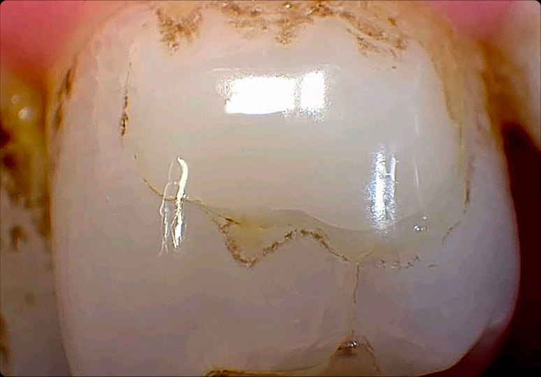 Single Molar